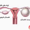 درمان-کیست-تخمدان-از-راه-طبیعی-سلامت-زنان