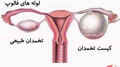 درمان-کیست-تخمدان-از-راه-طبیعی-سلامت-زنان