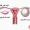 درمان کیست تخمدان از راه طبیعی | سلامت زنان